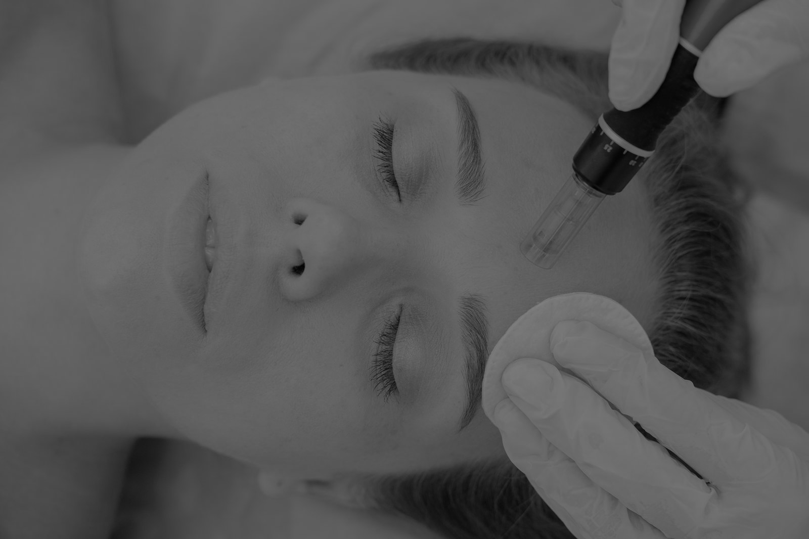 Microneedling